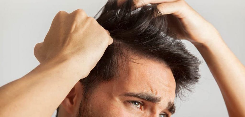 علائم و درمان ریزش مو هورمونی در آقایان 