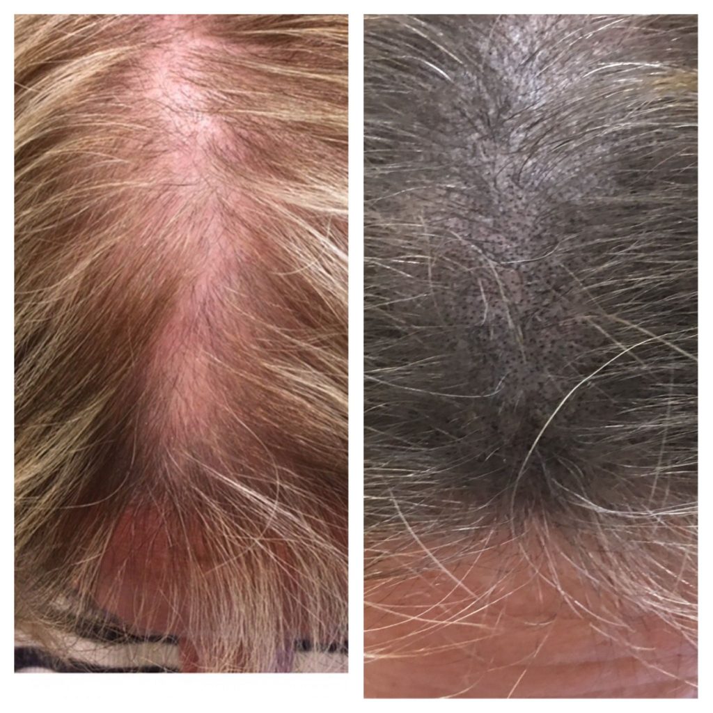  علت ریزش مو در زنان در سنین مختلف و درمان،رویش مجدد مو و قطع ریزش مو در زنان مسن و جوان