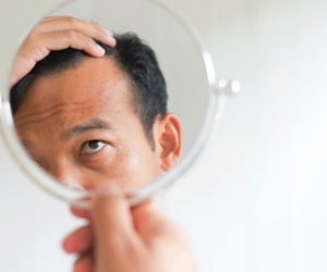 علائم ریزش موی ژنتیکی در مردان و زنان و درمان ریزش موی ژنتیکی
