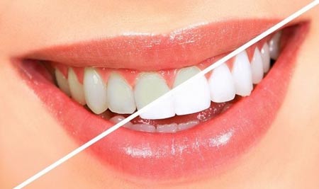 فواید جوش شیرین برای دندان و نحوه استفاده از آن برای سفید کردن دندان ها