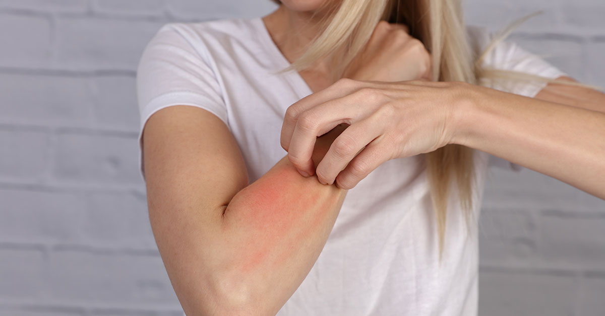  درمان‌های خانگی برای آلرژی پوستی