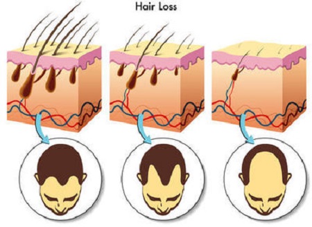 روش درمان ریزش مو و رشد مو با سلول های بنیادی 