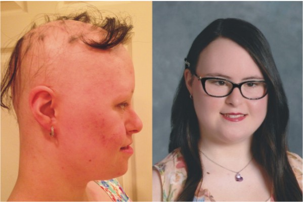 آلوپسی در بیماران سندروم داون / تشخیص ، علل و درمان ریزش مو در افراد مبتلا به سندروم داون