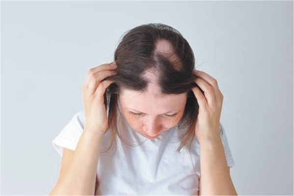 ارتباط تالاسمی و ریزش مو چیست؟ درمان ریزش مو و رشد مجدد مو در بیماران تالاسمی و فقر آهن