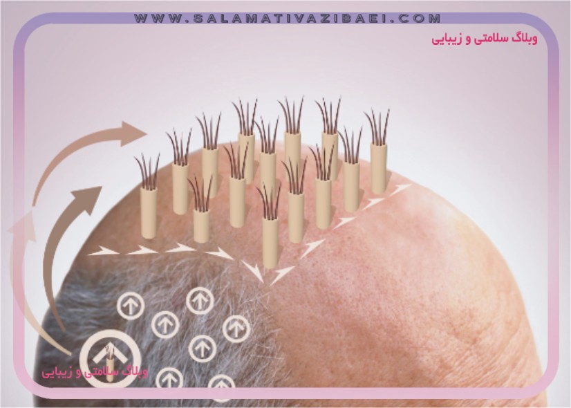 کاشت مو مستقیم چیست ؟ فواید ، معایب و نحوه کاشت مو به روش DHI
