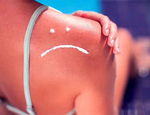 علائم مسمومیت با نور خورشید و روش های پیشگیری و درمان آفتاب سوختگی شدید