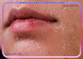 علل خشکی پوست اطراف دهان، پیشگیری و درمان خانگی خشکی پوست اطراف دهان