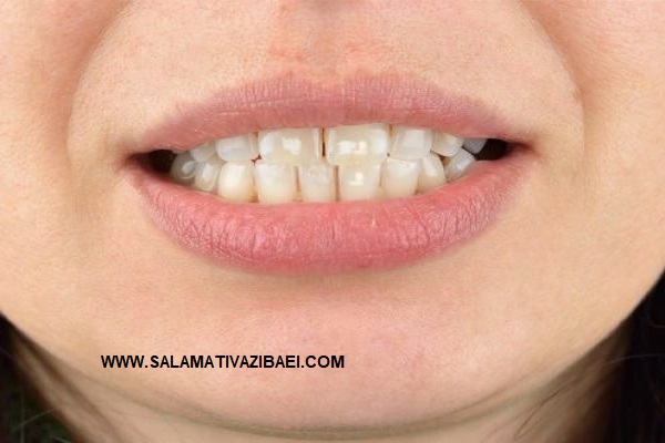 علل لکه های سفید روی دندان، انواع لکه روی دندان و روش های درمان و پیشگیری از لکه سفید روی دندان