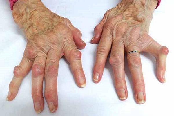 علل آرتریت انگشتان چیست؟ علائم و درمان آرتریت انگشتان