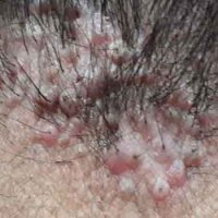 ریزش مو فولیکولیت چیست؟ انواع فولیکولیت، علل و علائم ریزش موی فولیکولیت و درمان آن