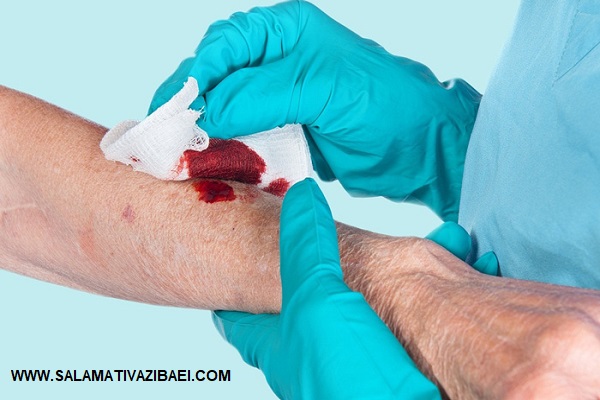 درمان خانگی برای توقف سریع خونریزی و پیشگیری از خونریزی زخم و نکاتی برای پیشگیری از عفونت